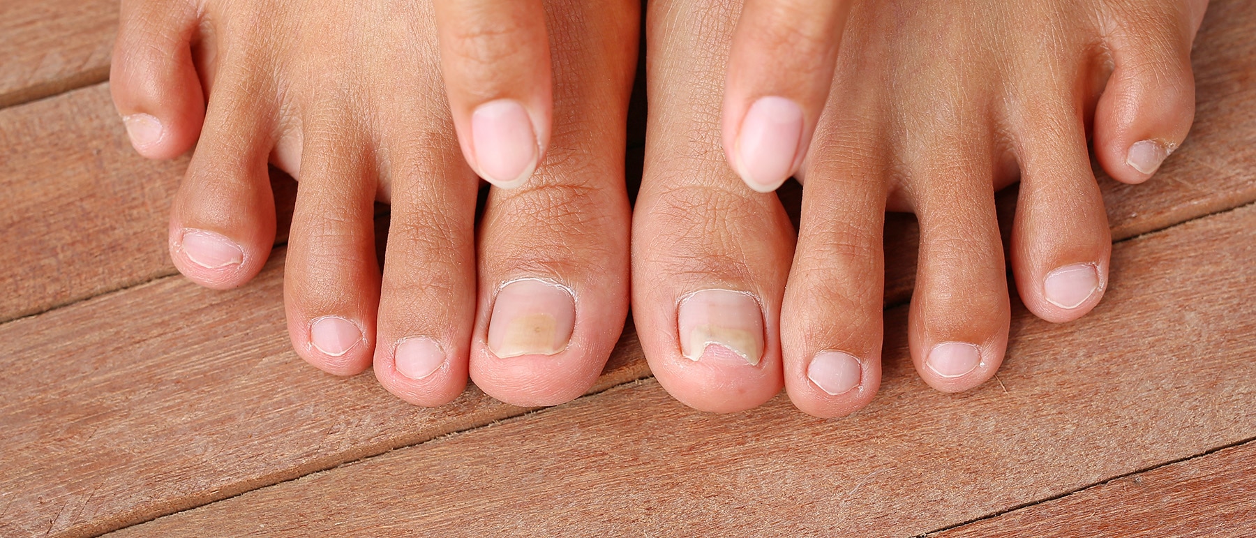 Point to Damaged toenail, broken nail