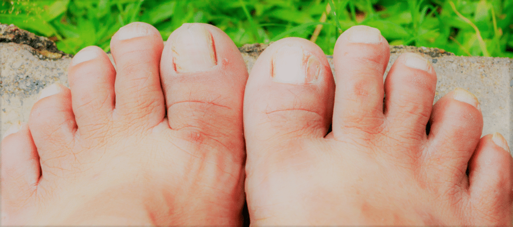 Ingrown Toenails 2 | Advanced Foot & Ankle Centers of Illinois