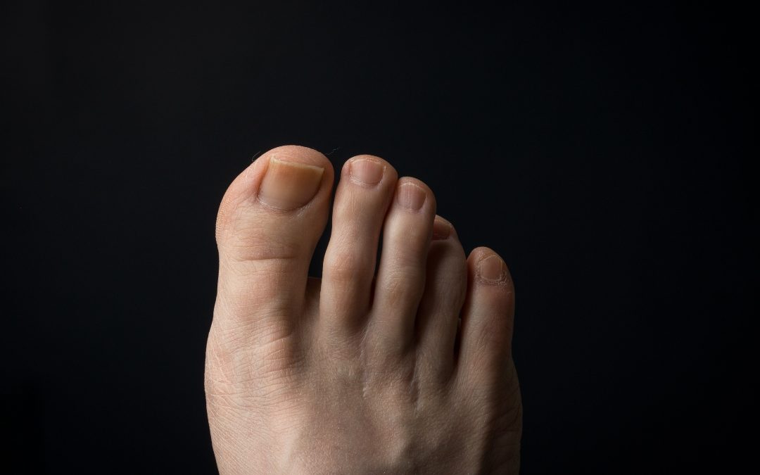 Morton’s Neuroma: Symptoms, Causes, Diagnosis & Treatment