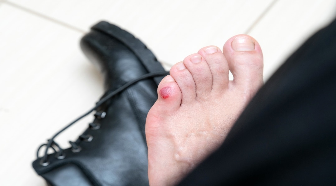 Blister On Pinky Toe | vlr.eng.br