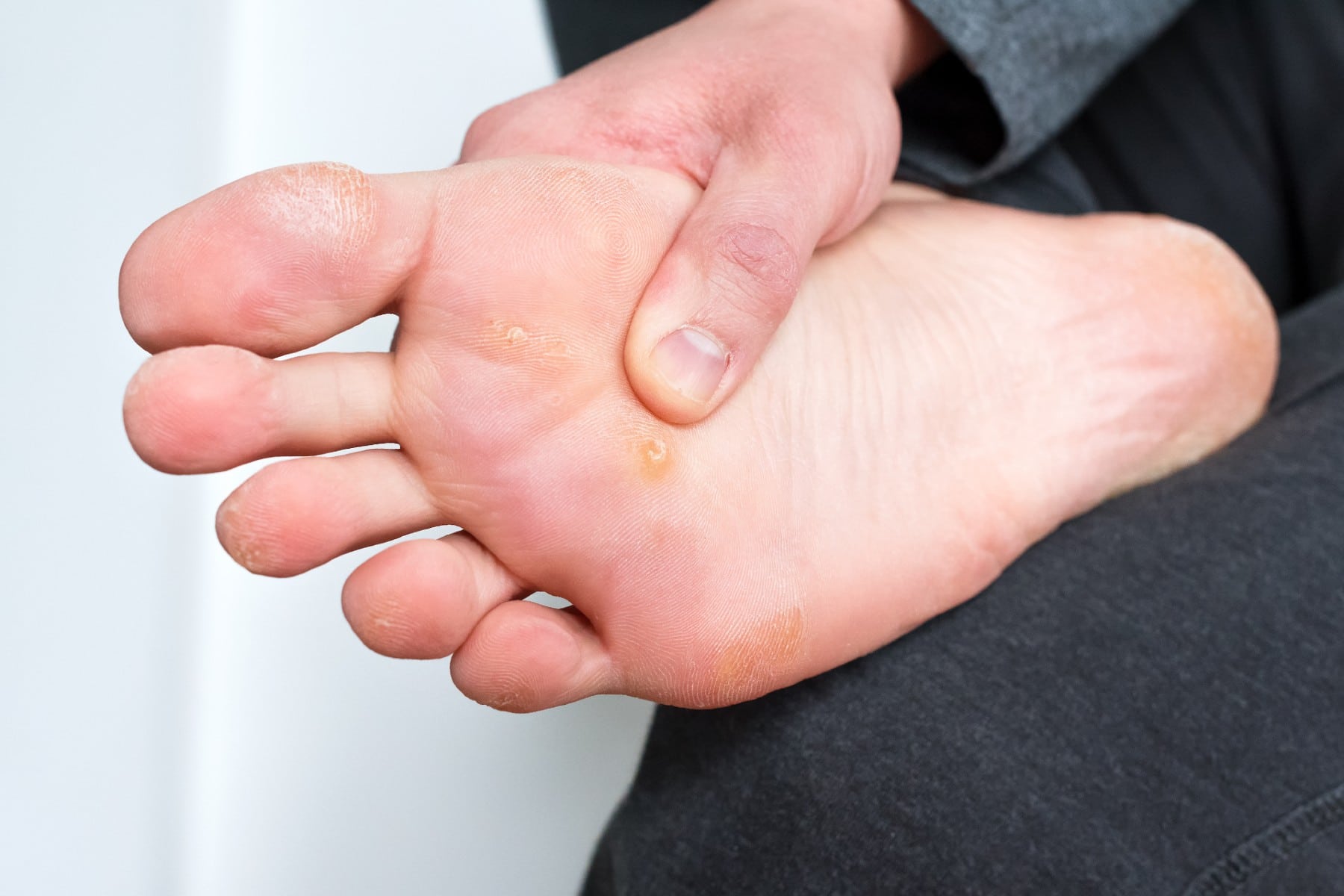 a man with a plantar wart on his foot