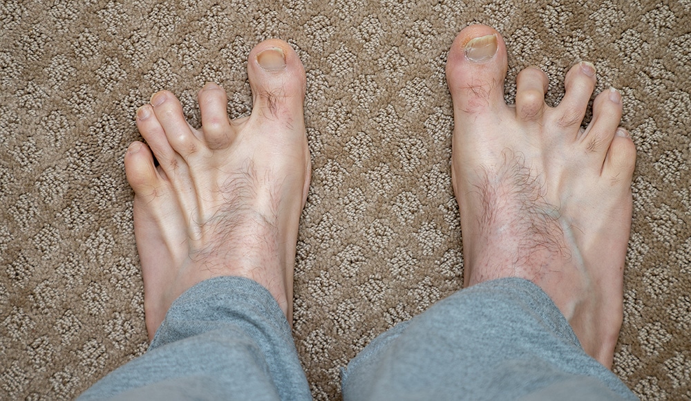 Mens hammer toes before surgery
