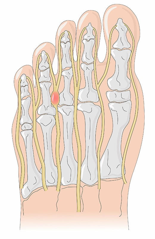 morton's neuroma in foot