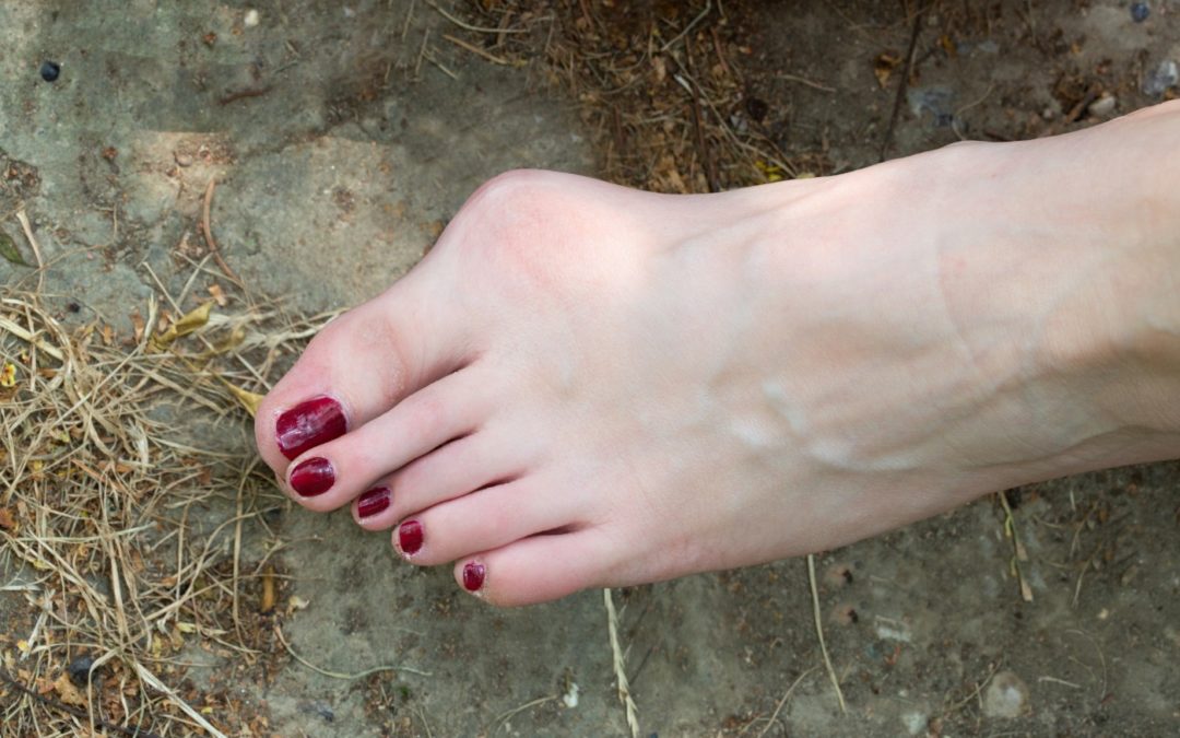 Living with Bunions – What Can You Do to Alleviate Your Pain?