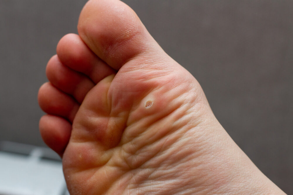Foot with plantar warts that would benefit from Swift therapy
