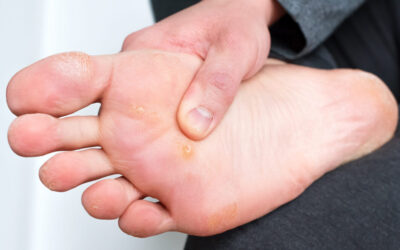 How Does Swift Therapy Treat Plantar Warts?