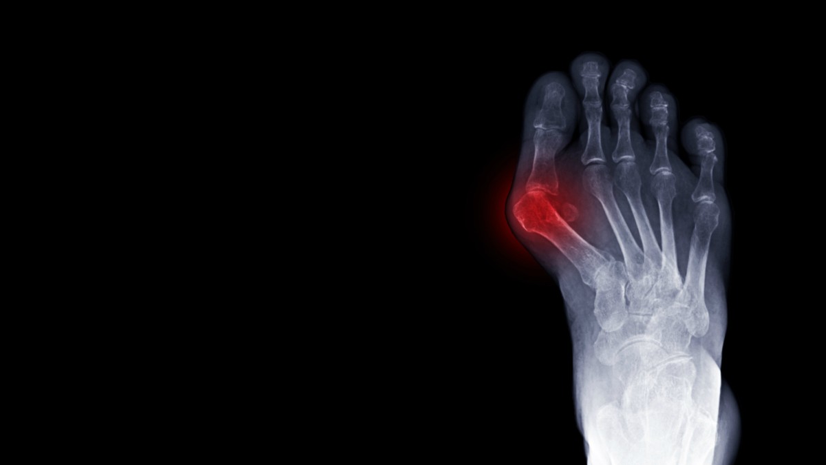 Lapiplasty Bunion Surgery // Advanced Foot & Ankle Centers of Illinois