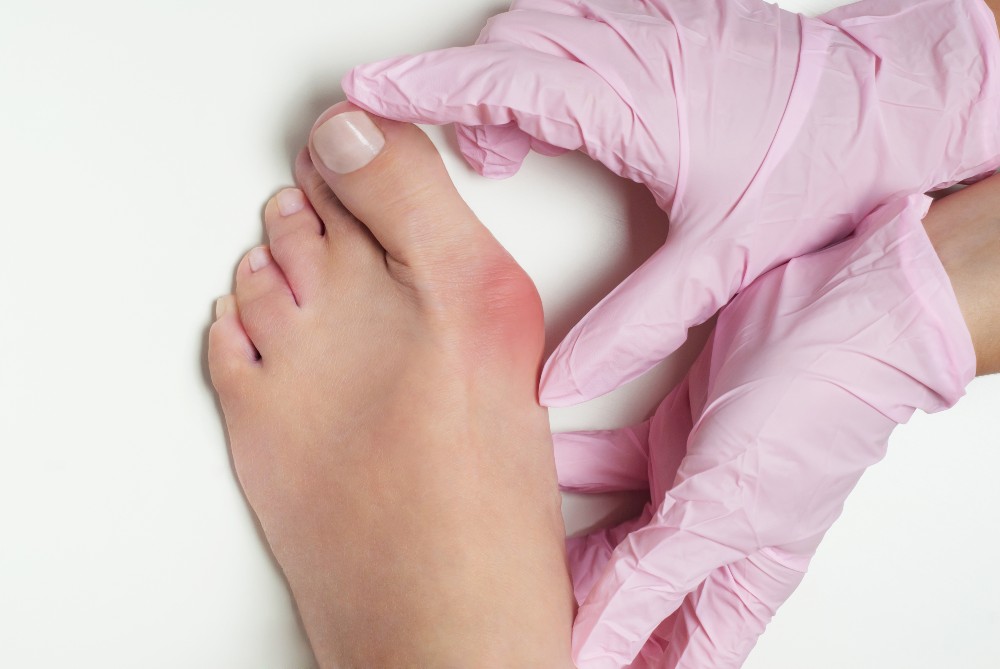 Doctor evaluating a foot with a bunion