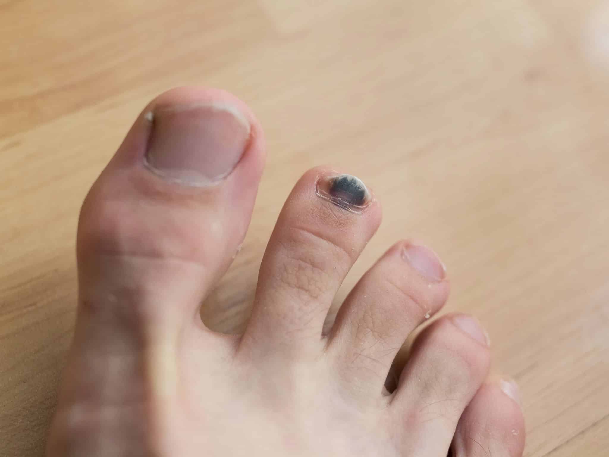 Black toenail after injury - ugly dark blood under nail on the foot of caucasian person. Health problem with toe and finger.
