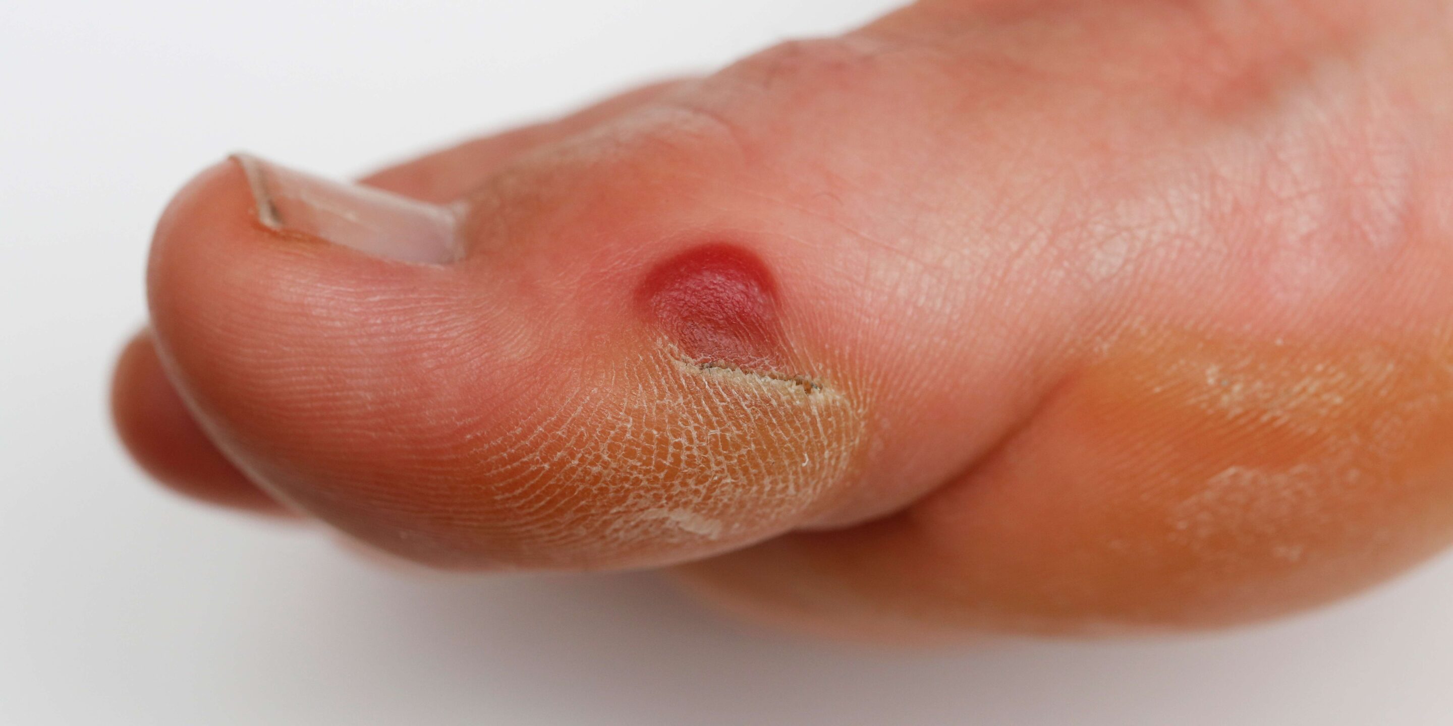 Close up on foot with callous and blister