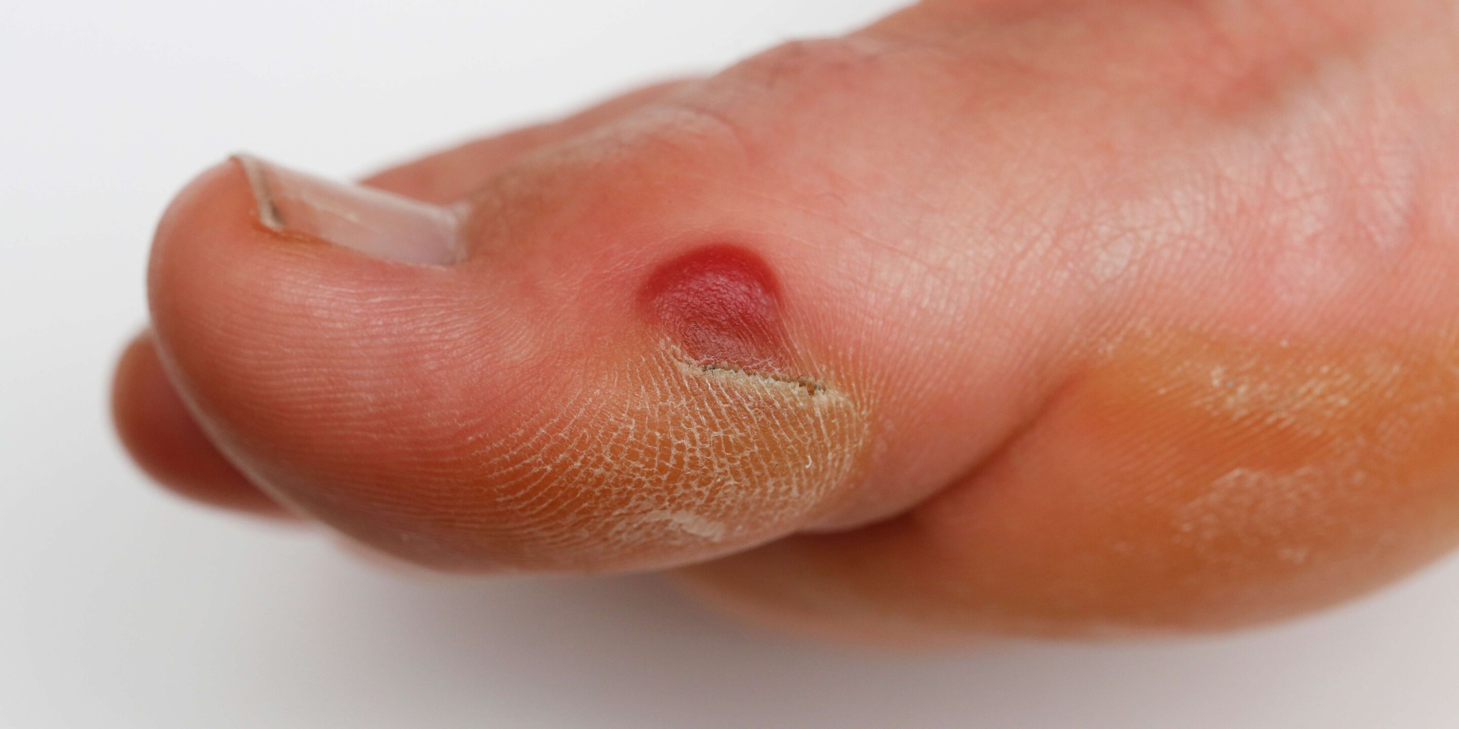 What causes shop blood blisters