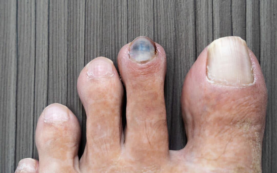 Black Toenails