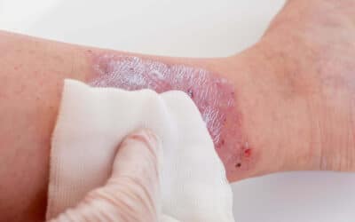UltraMist Therapy for Diabetic Wound Care | Advanced Foot and Ankle Center of Illinois